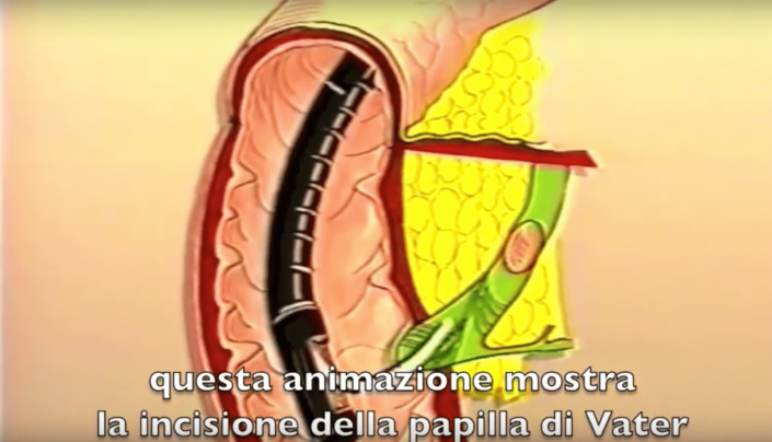 Asportazione calcoli coledoco