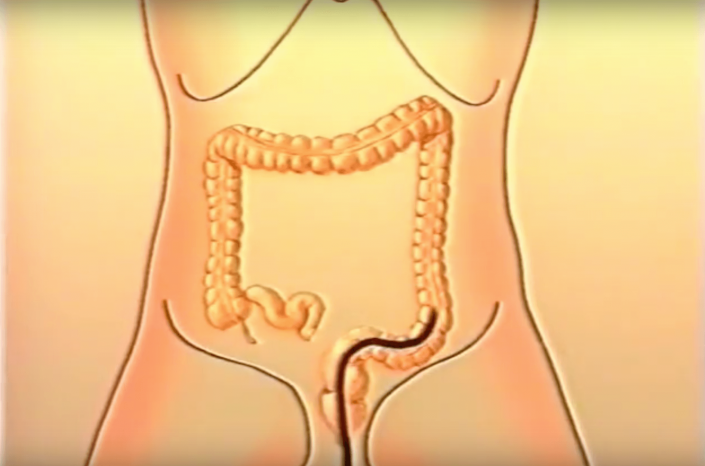 Colonscopia